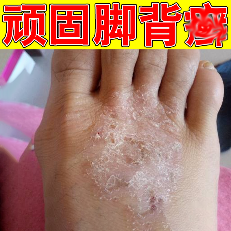 冶疗脚背痒脚趾头关节上硬皮疙瘩脚背起皮干燥脱屑皮肤起皮专用膏