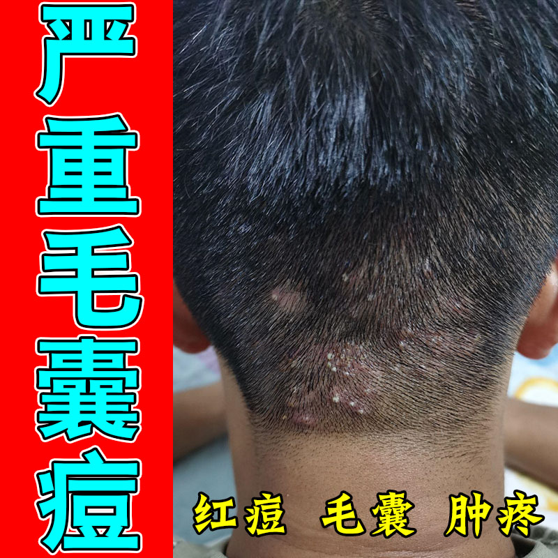 头皮毛囊疙瘩头上长痘硬块疙瘩头部红肿起干皮粗糙发痒保湿舒缓膏