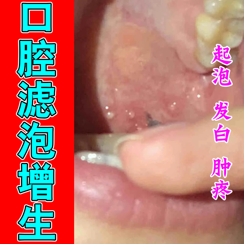 咽喉淋巴滤泡增生喉咙舌壁泛红灼热异物感草本润喉喷剂