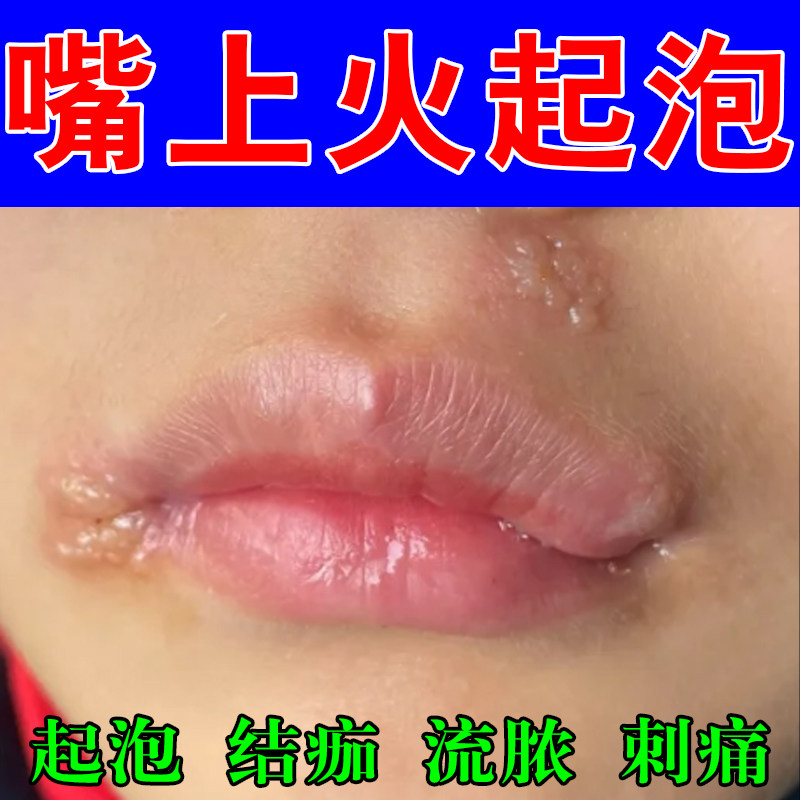 嘴巴上火起泡嘴唇干裂脱皮医用型唇上火用保湿滋润口角上火水泡膏