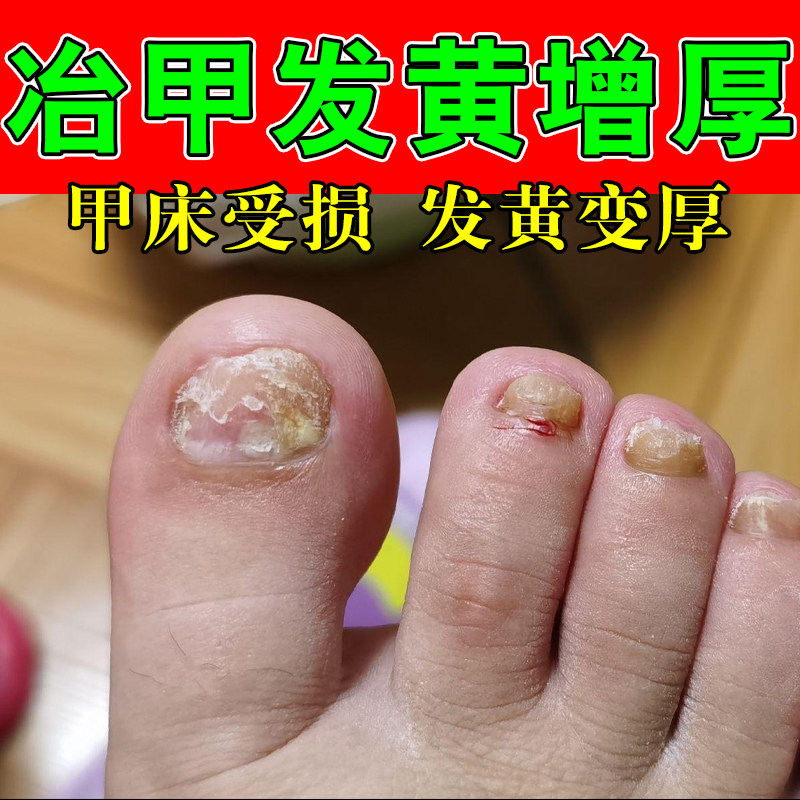 指甲快速生长甲床受损分离变硬增厚空护甲坏甲植物萃取修复指甲液