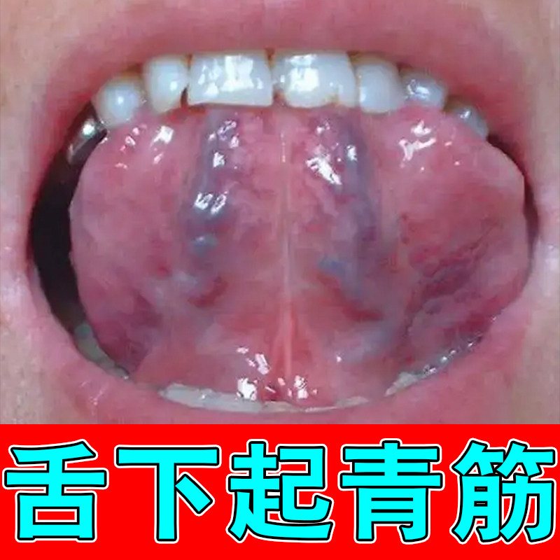 舌下青筋又黑又粗舌头底黑紫血管肝火旺草本舒缓喷剂
