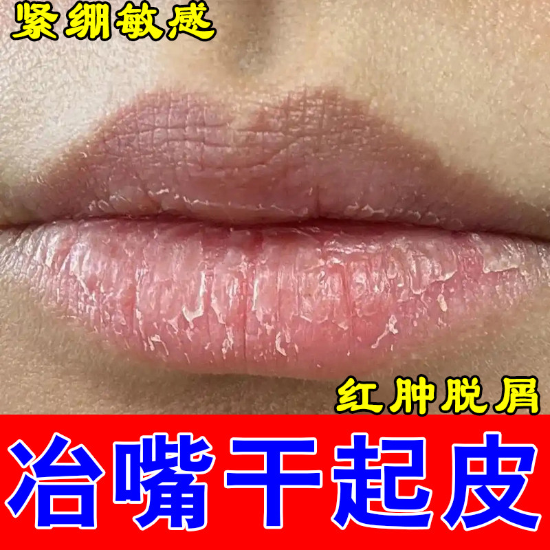 唇干硬起皮爆裂落皮发灰爆裂唇皮剥落沟壑深重滋养修护唇膏