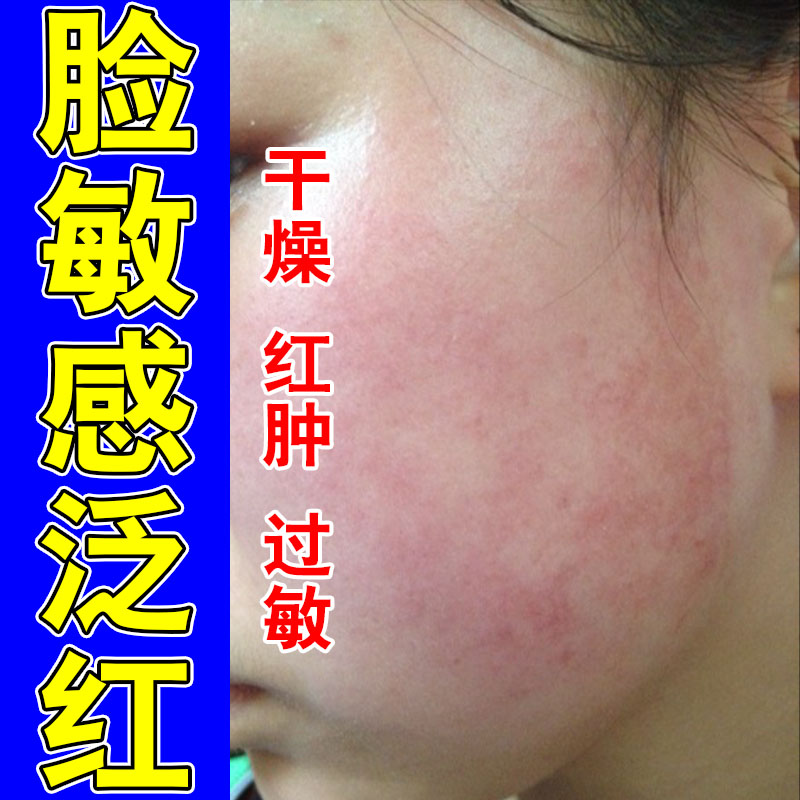面部泛红干痒刺痛起皮肌肤敏感发红植物萃取舒缓修护膏