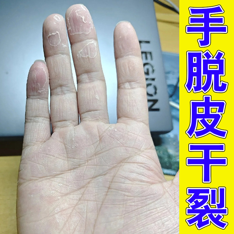 手干燥脱皮掉屑手部掉皮裂口季节性掉皮手心小疙瘩痒