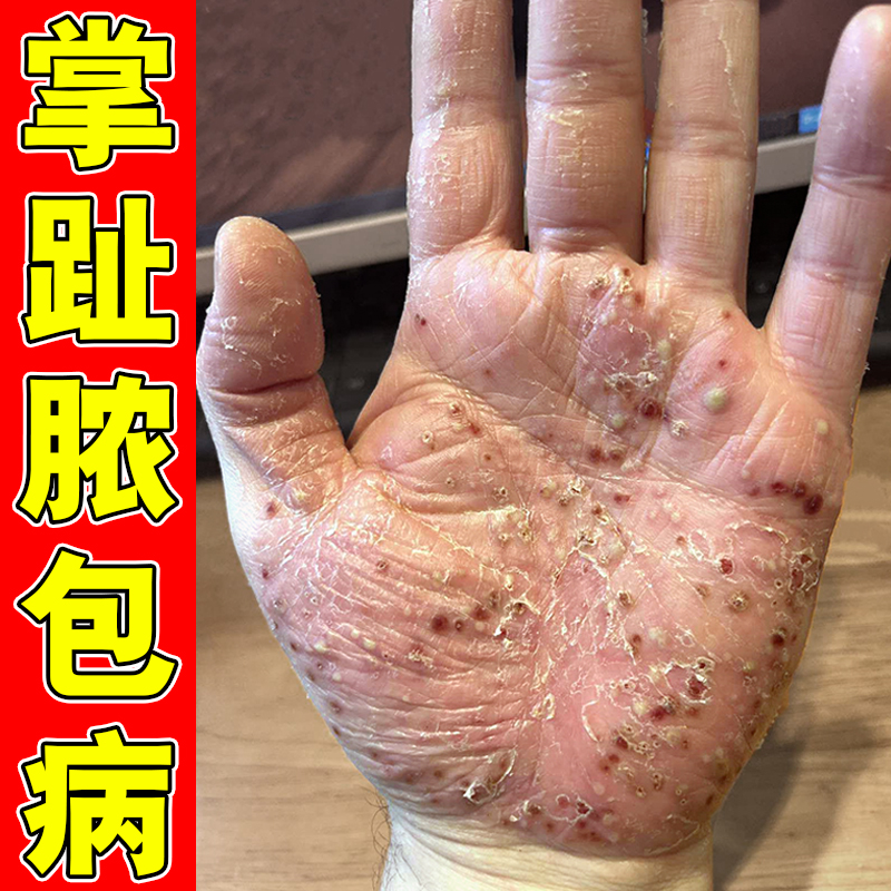 掌趾脓疱病症专用药膏掌跖角化症手脚红斑干裂蜕皮角皮症掌跖脓包