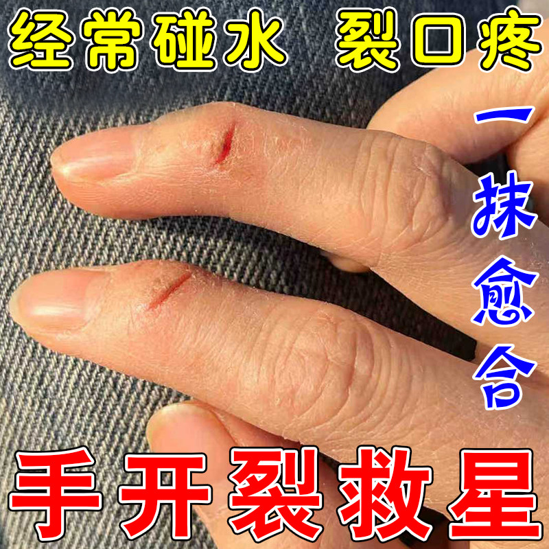 手干裂脱皮真菌蜕皮手指严重裂口脚后跟干裂防开裂愈合修复霜