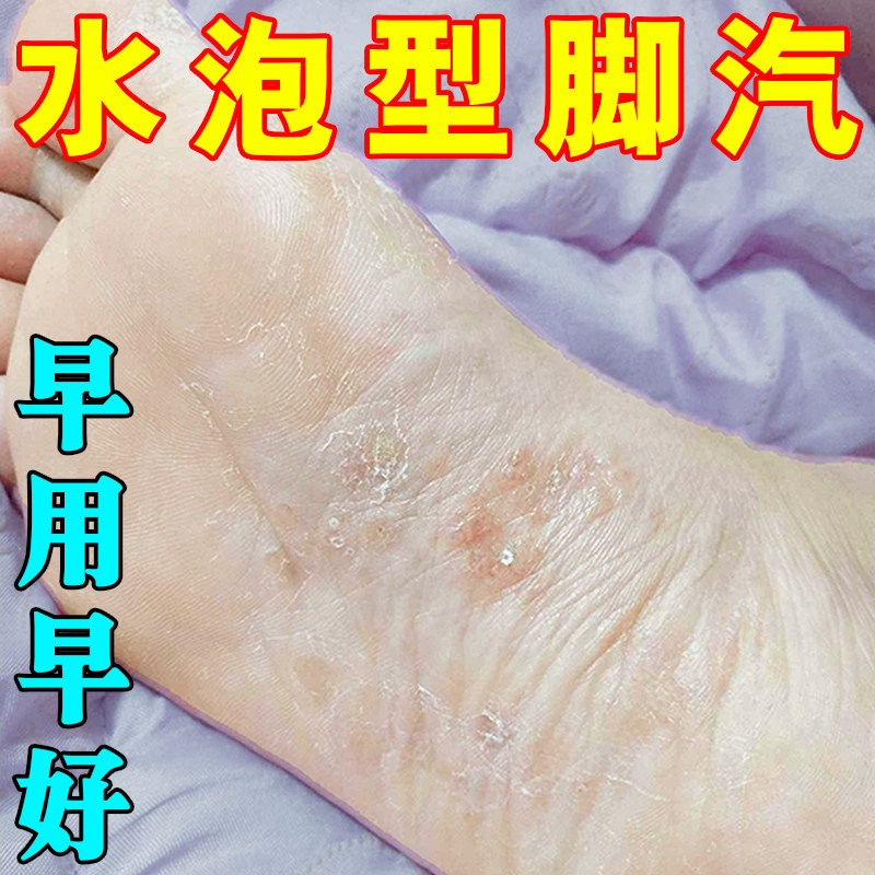 脚底起泡又痒又脱皮疗脚掌心