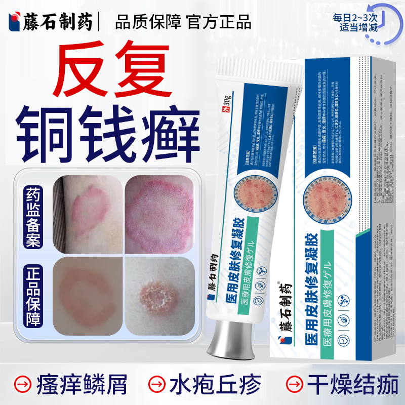 铜钱癣专用膏皮肤瘙痒外用止抑痒菌去癣膏贴体癣真菌感染皮炎OZ