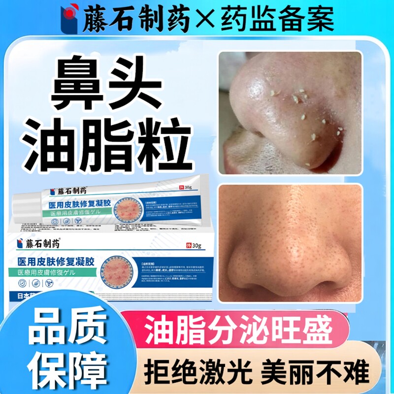 鼻子上脂肪粒去油脂粒鼻头疖肿脂溢性皮炎去白色粒颗粒粉刺闭口OZ