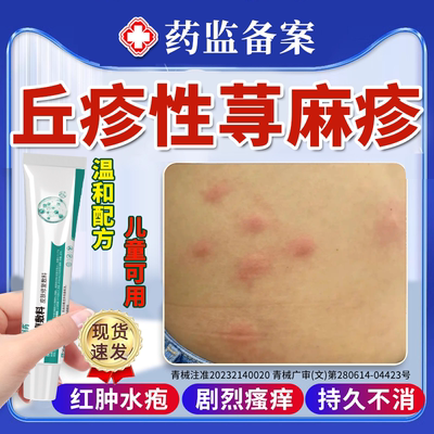 【现货速发】丘疹性荨麻疹专用膏