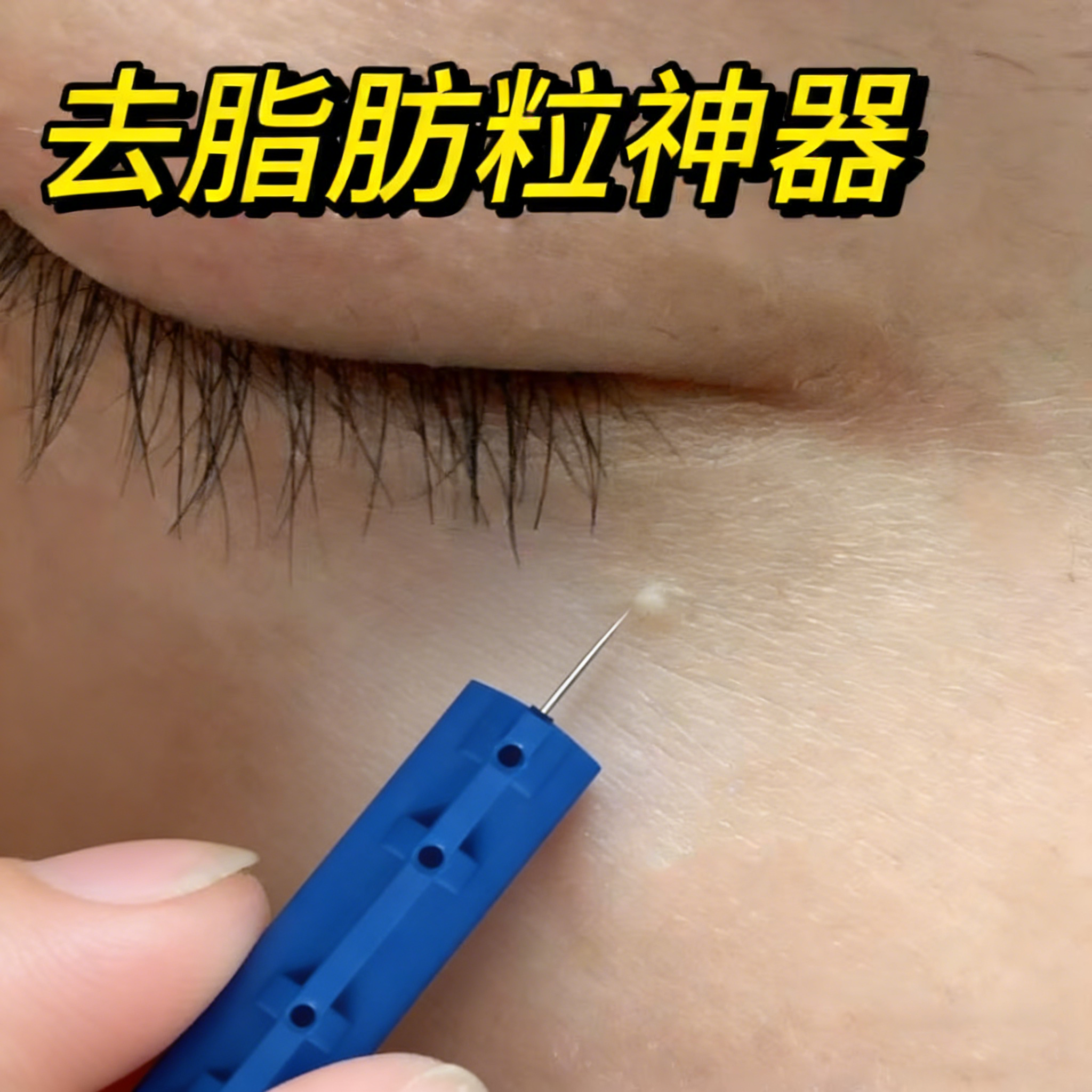 医用去眼部脂肪粒去除神器挑针专用挑脂肪粒针的眼睛下面小颗粒OZ,医疗器械,保健理疗,淘宝优惠券,粉丝福利购,淘宝优惠卷