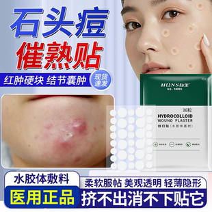 祛石头痘红肿硬块医用痘痘贴下巴反复长痘催熟修复消炎痘印吸脓QF