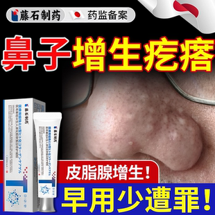 鼻子鼻头长肉疙瘩面部皮脂腺增生专鼻翼两侧小颗粒用药监备案膏EM