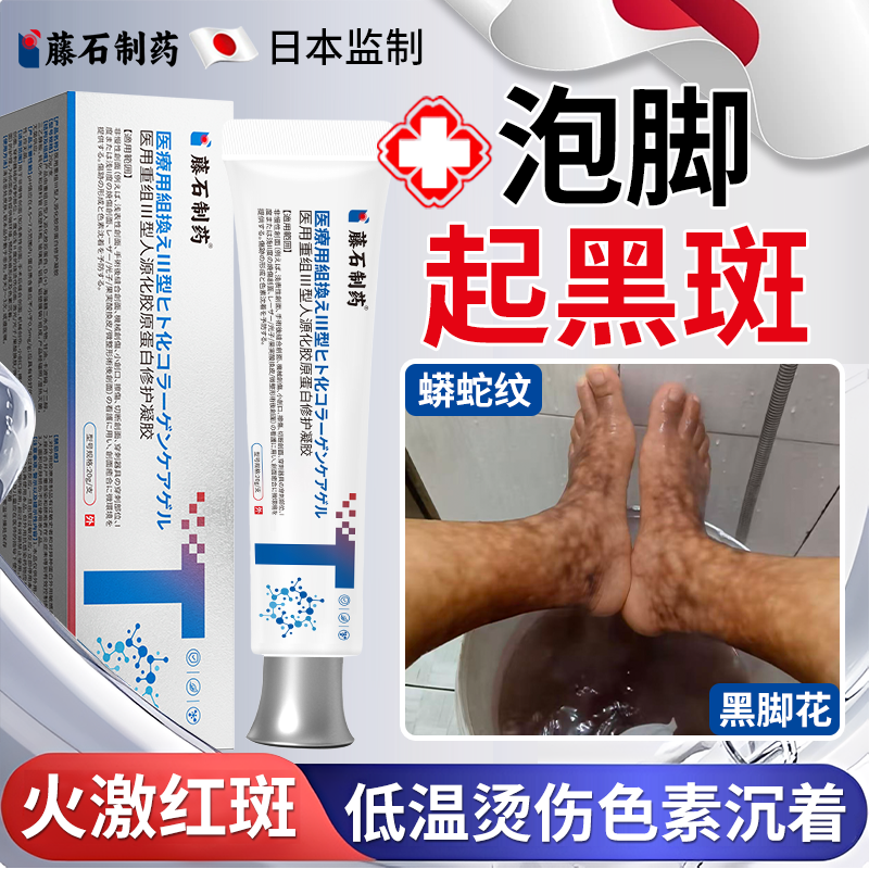 泡脚后低温烫伤火激红斑药房同款膏祛去烤火斑梅花斑蟒蛇纹脚花OZ