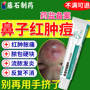 鼻子上长脓包红肿痘痘去红鼻头鼻尖红肿火疖子痤疮毛囊炎肉疙瘩DZ