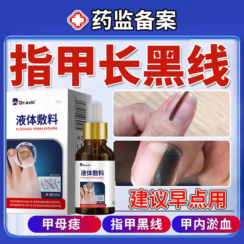 甲母痣指甲黑线变黑灰指甲