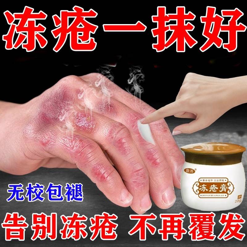 冻疮膏止冻伤痒膏排行榜名手脚干裂起皮防冻保湿护手霜W防裂