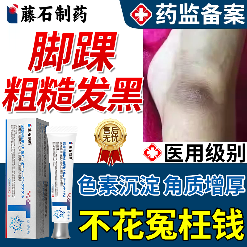 脚踝发黑去黑脚脖子黑色素沉淀增厚硬干除黑棘皮关节手肘医用型MP
