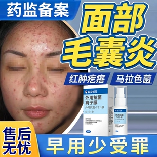 脸上长痘痘毛囊炎硬起小疙瘩痤疮马拉色菌额头喷雾剂痒药房同款DZ