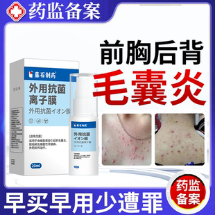 背上长痘痘毛囊炎除螨祛痘痒前胸后背马拉色菌背部背后胸口JW