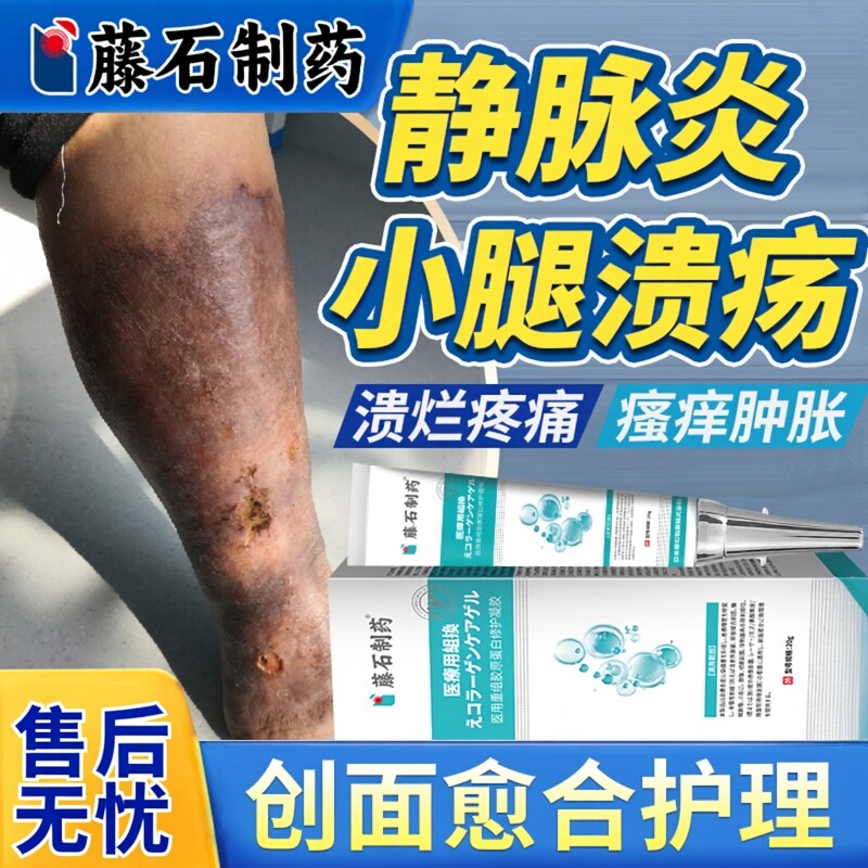 静脉炎血栓静脉曲张小腿溃疡肿痛专用老烂腿贴药房同款膏弹力袜EM