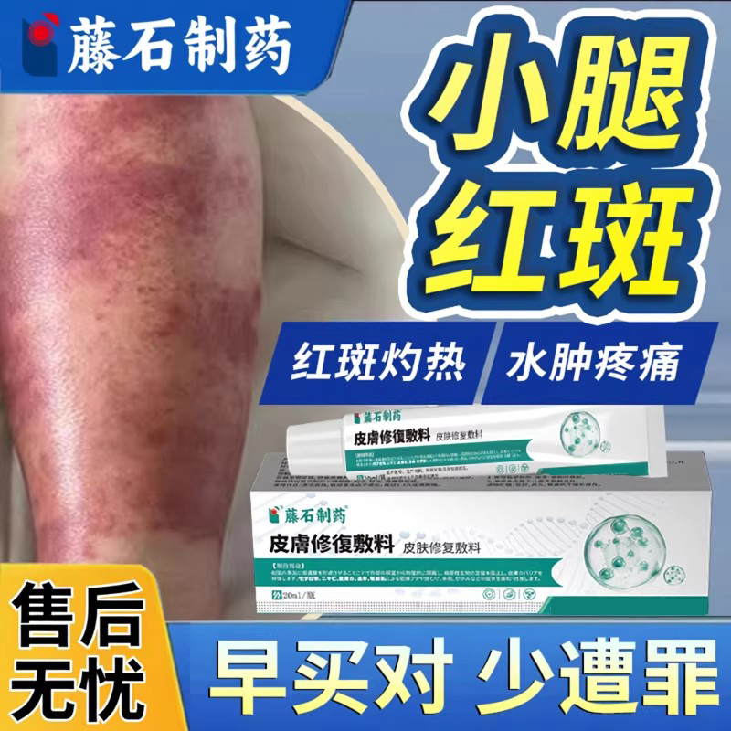 丹毒专用下肢淋巴水肿静脉炎药房同款膏小腿皮肤红肿疼痛灼热胀DZ