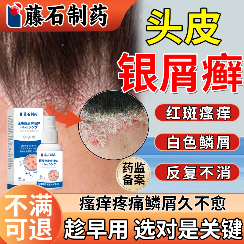 【头皮银屑癣瘙痒久不好】试试它