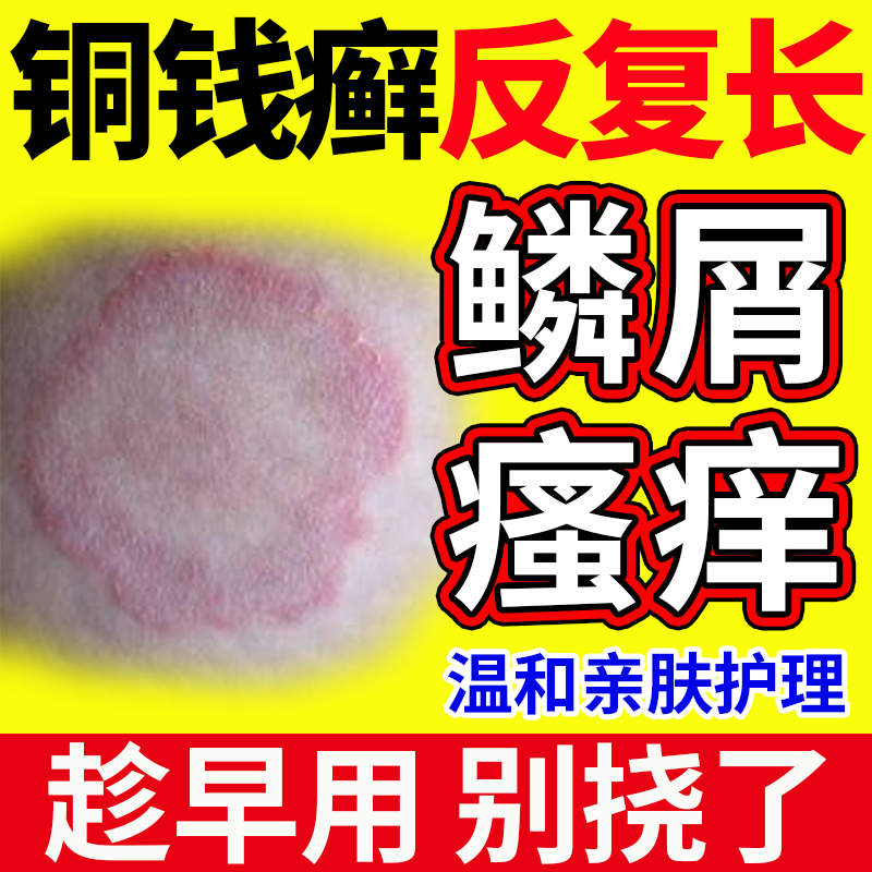 铜钱癣体癣专用去癣可搭药房同款膏真菌感染外用皮肤金钱癣体藓OZ