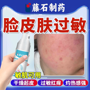 过敏皮肤修复脸部医用脸上面部过敏性皮炎专用干燥药房起皮红痒OZ