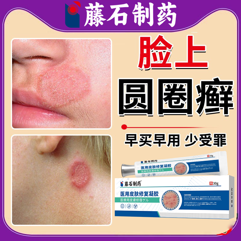 脸上长癣猫藓人用圆圈红斑真菌感染体癣止痒去专用顽固皮炎根BS