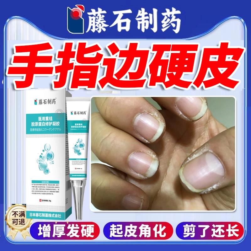 【指甲两侧硬皮】软化手指硬皮膏