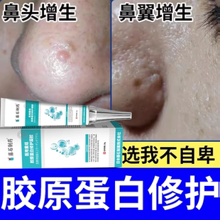 鼻部皮脂腺增生增大面部粟丘疹鼻头鼻翼去鼻子上小肉疙瘩起丘疹BS