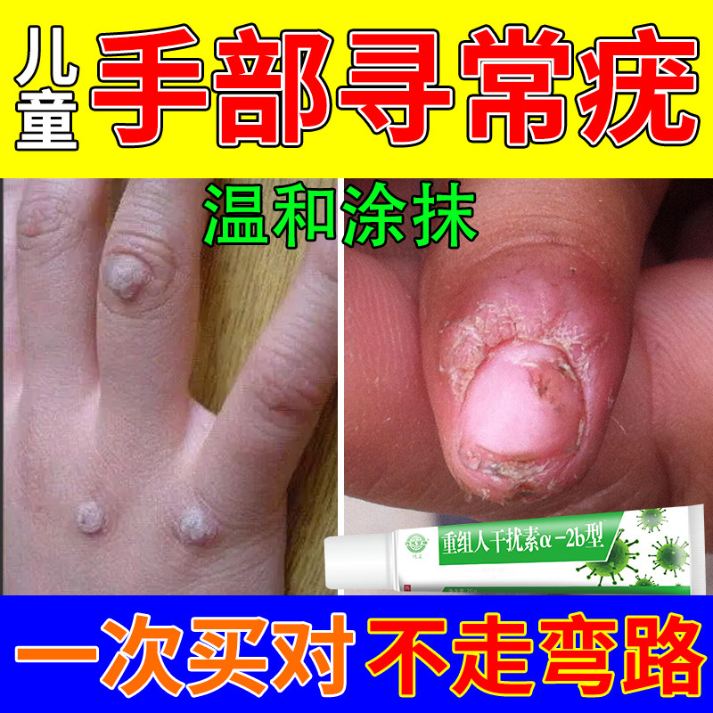 手部寻常疣神器刺猴甲周疣水去除专用扁皮疣瘊子点药房同款膏yr