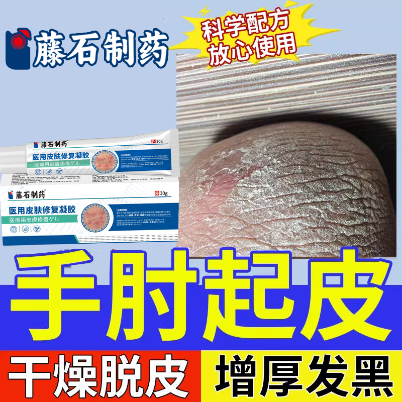 手肘起皮硬皮皲裂胳膊肘皮肤硬化癣发黑增厚干燥脱皮神经性皮炎JW