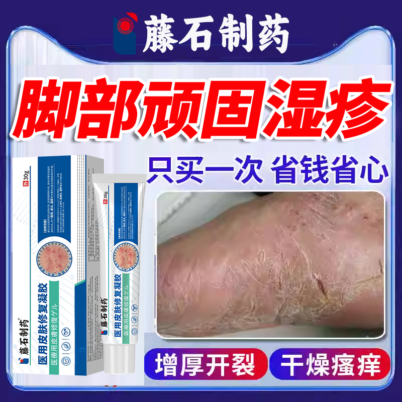 角化型湿疹脚藓足癣脚癣一次净药房同款膏真菌感染皲裂开裂脚气OZ