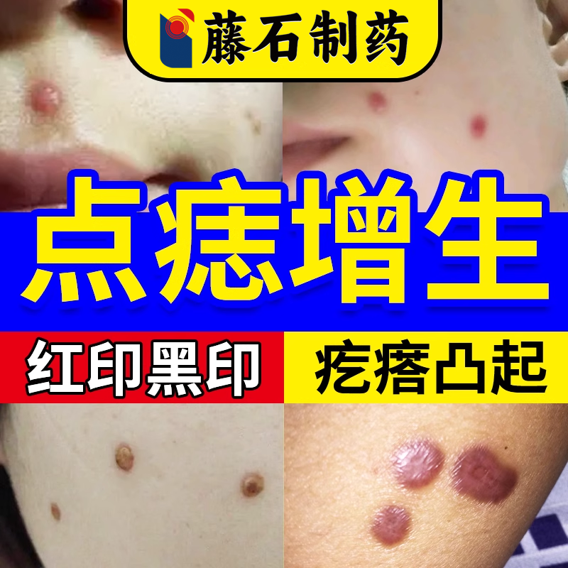 点痣后疤痕增生凸起疙瘩点斑专用修去脸上祛红印激光去除复膏OZ