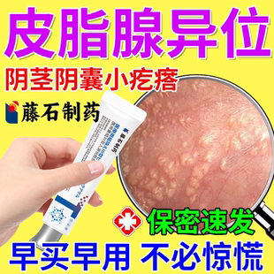 皮脂腺异位症阴囊阴茎包皮私处小疙瘩白点脂肪粒潮湿瘙痒生殖器OZ