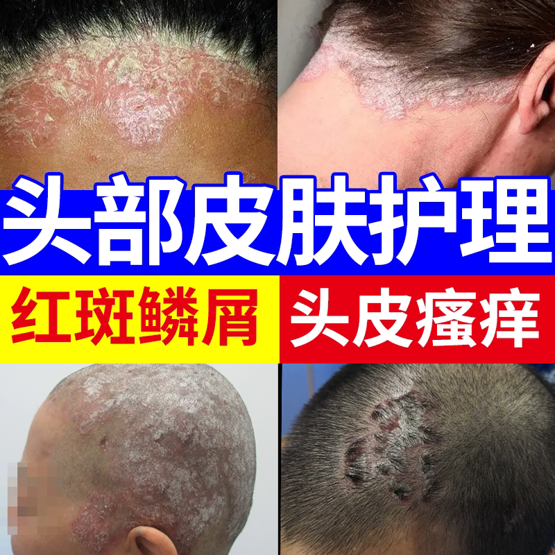 头部牛皮癣藓鲜银屑病头皮屑专用膏头癣真菌感染洗发水药房同款JW