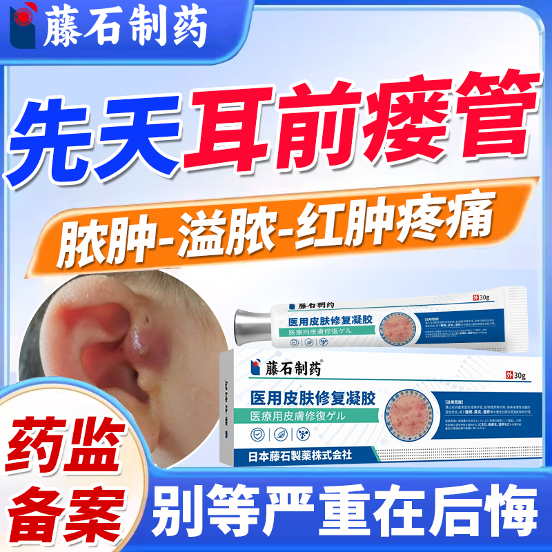 【医用级】耳前瘘管红肿疼痛脓包