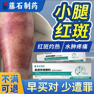 丹毒专用下肢淋巴水肿静脉炎药房同款膏小腿皮肤红肿疼痛灼热胀DZ