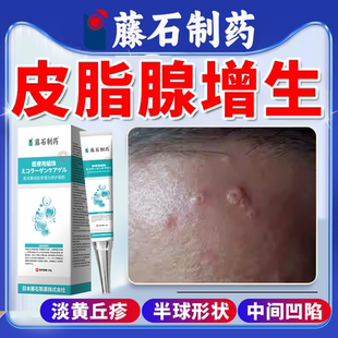 皮脂腺增生增大面部胸前囊肿丘疹肚脐样凹陷早熟性老年性小疙瘩OZ