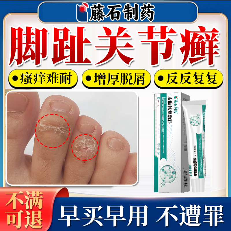 脚趾头关节癣湿疹痒脚被面专用干燥起皮真菌感染足癣药房同款膏CF