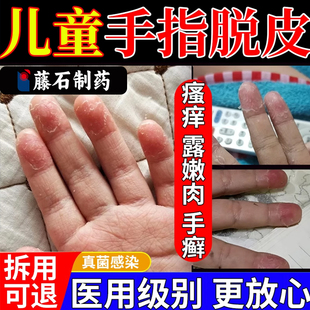 儿童手指头尖肚脱皮裂口子开裂严重湿疹专用手癣膏手足真菌感染YS