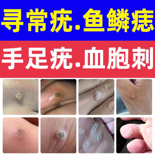 手足疣寻常疣脚底鱼鳞痣鱼休子