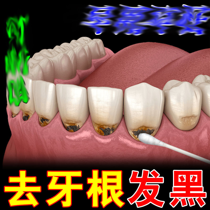 牙根发黑去除牙垢牙菌斑牙烟渍牙斑净去牙缝发黑清理神器氟斑牙药