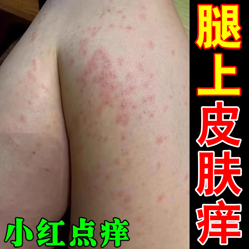 腿上皮肤痒小红点疙瘩过敏干燥粗糙痒大腿内侧痒男士私处阴囊潮湿