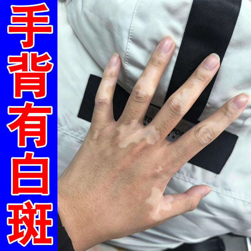 手背有白斑促进黑色素生长补骨脂酊外用修复男女手上白斑