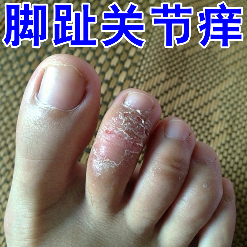 脚趾关节痒干燥去硬皮掉屑真菌脚痒脚面脚背皮肤痒手脚脱皮干裂痒