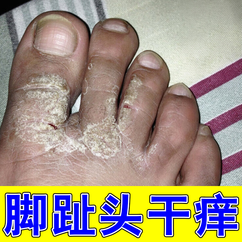 脚趾头干燥掉白色鳞屑起皮红斑疙瘩脚背脚趾缝干痒粗糙真菌外用药